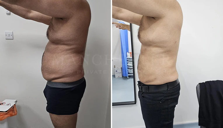 vaser liposuction male before and after patient-8-v3