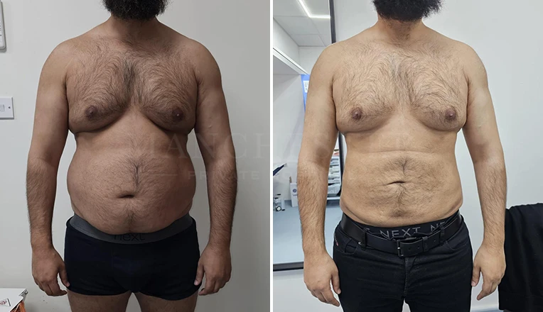 vaser liposuction male before and after patient-8