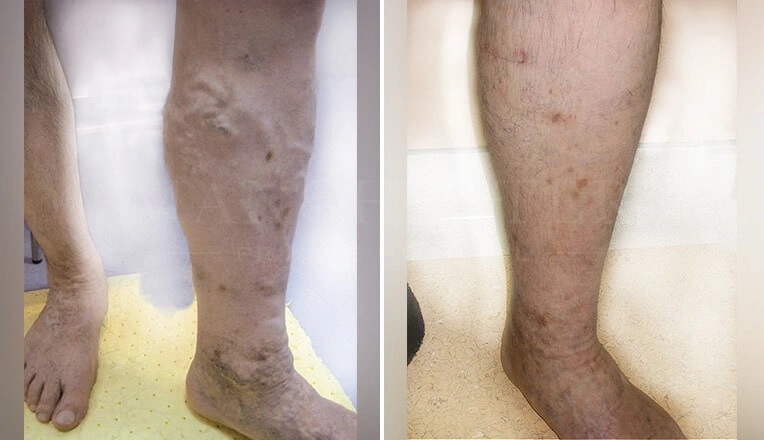 vericose-vein-before-and-after-1