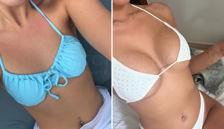 breast augmentation before and after patient-7