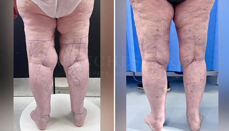 lipedema legs before and after result-2