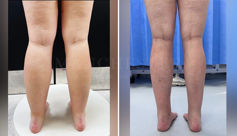 lipedema legs before and after result
