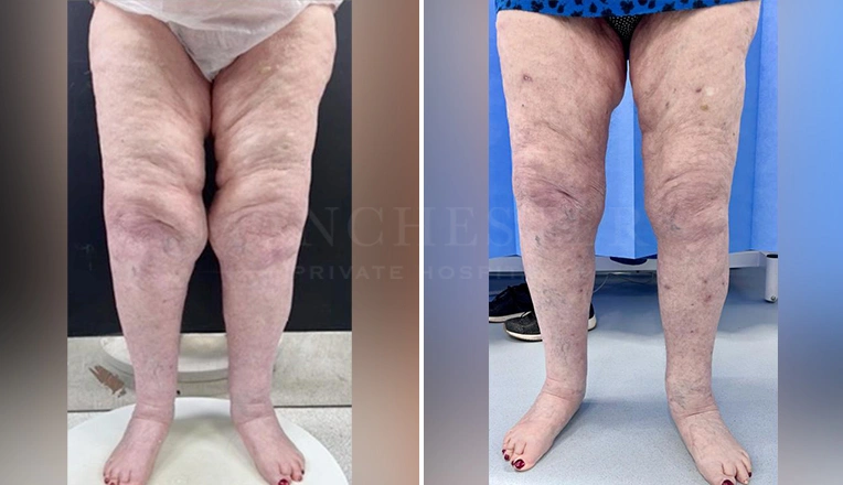 lipedema surgery before and after-2