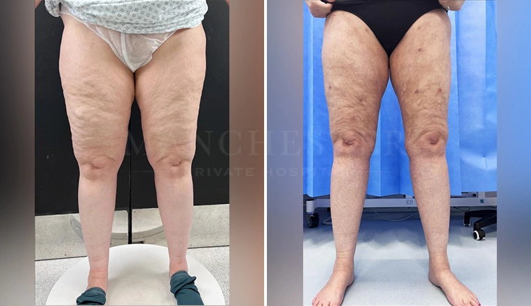 lipedema surgery before and after
