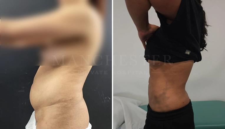 vaser lipo female abs before and after-7-v1