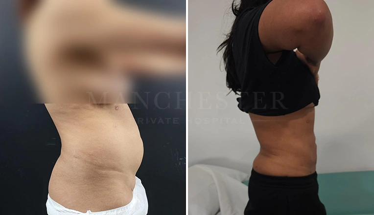 vaser lipo female abs before and after-7-v2