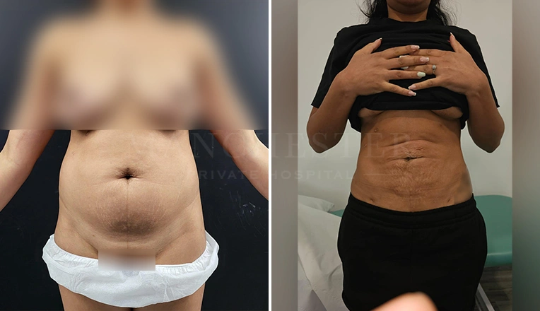 vaser lipo female abs before and after-7
