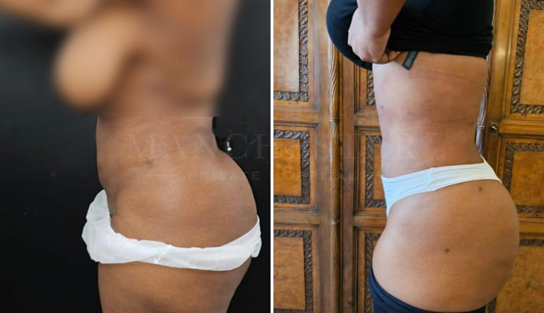 vaser lipo female abs before and after-8-v1