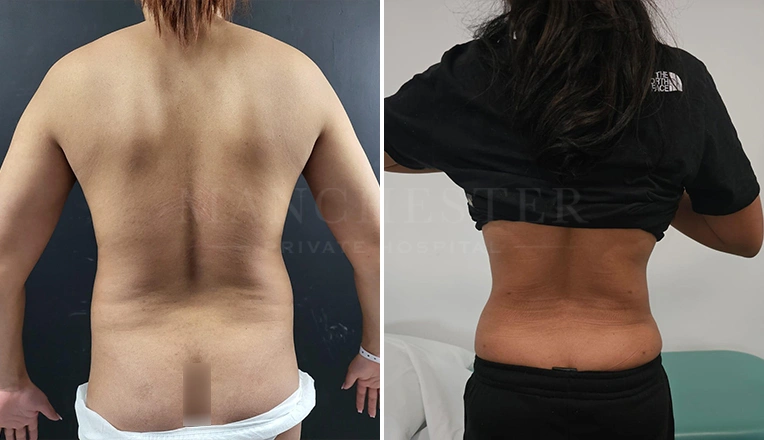 vaser lipo female back before and after-7-v3