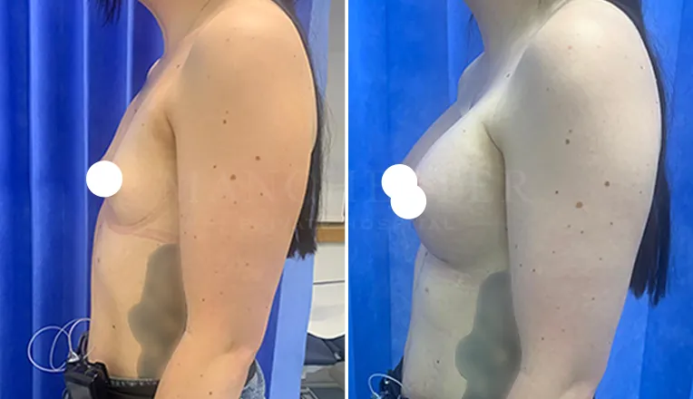 boob job before and after patient-10-v1