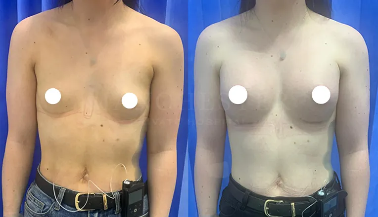boob job before and after patient-10