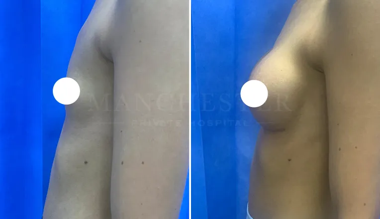 boob job before and after patient-9-v1