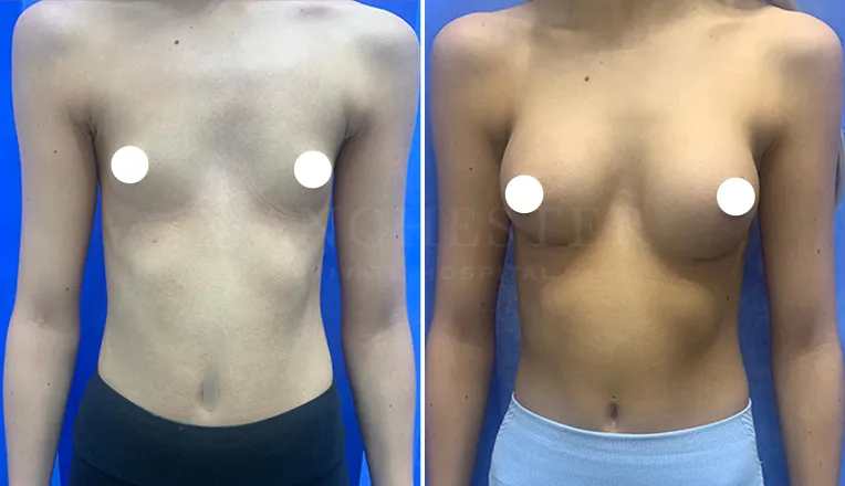 boob job before and after patient-9