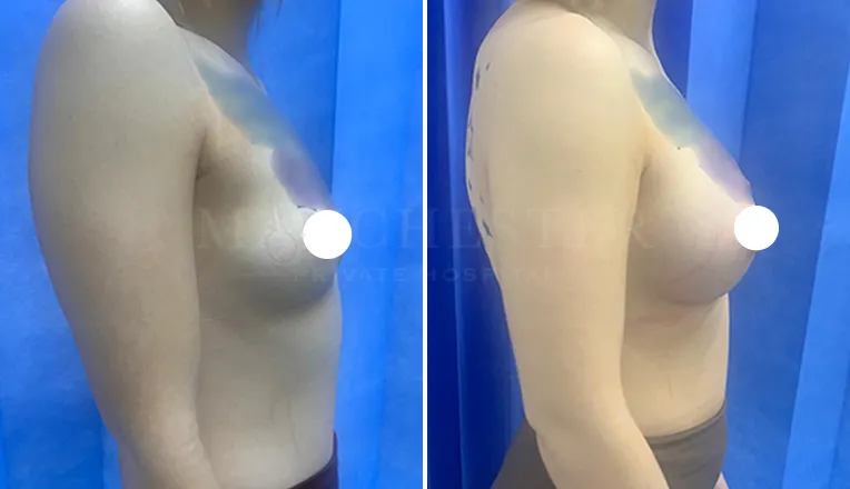 breast augmentation before and after patient-7-v1