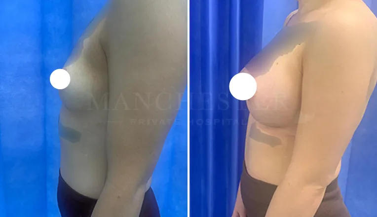 breast augmentation before and after patient-7-v2