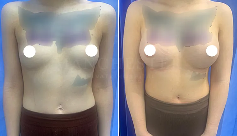breast augmentation before and after patient-7