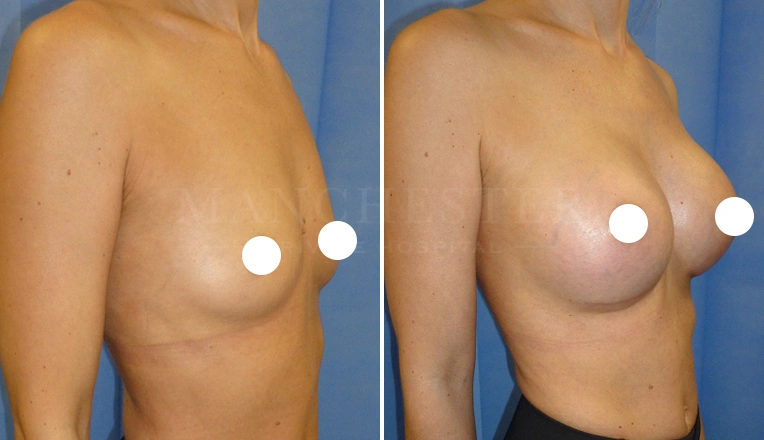 breast augmentation before and after result - patient 2