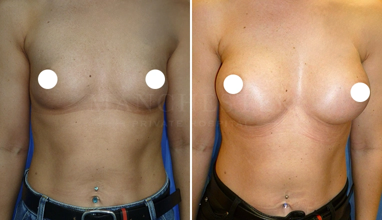 breast augmentation before and after result - patient 3