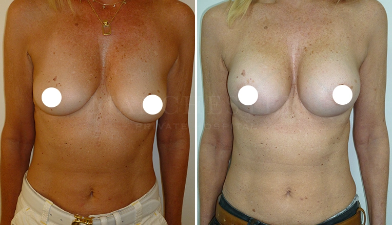breast augmentation before and after result
