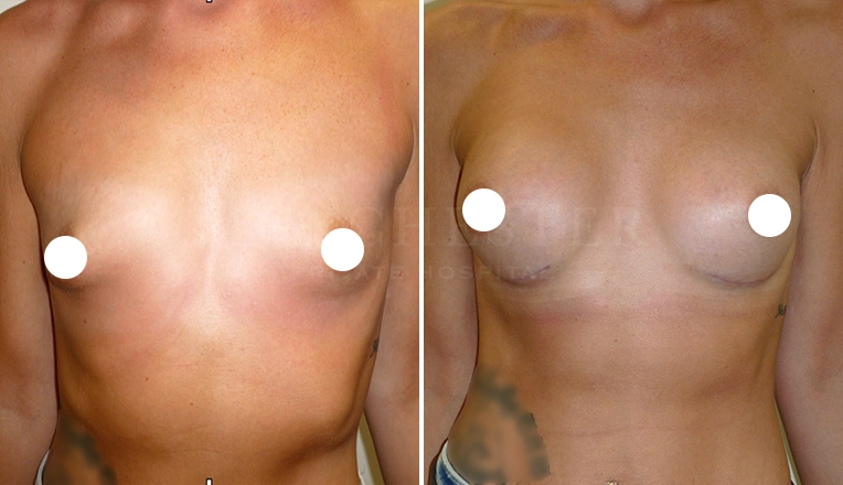 breast enlargement before and after result - patient 4