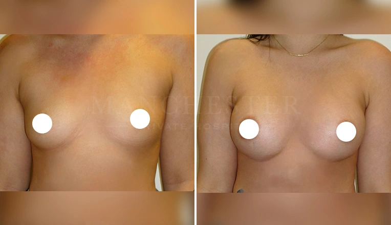 breast enlargement before and after result - patient 5