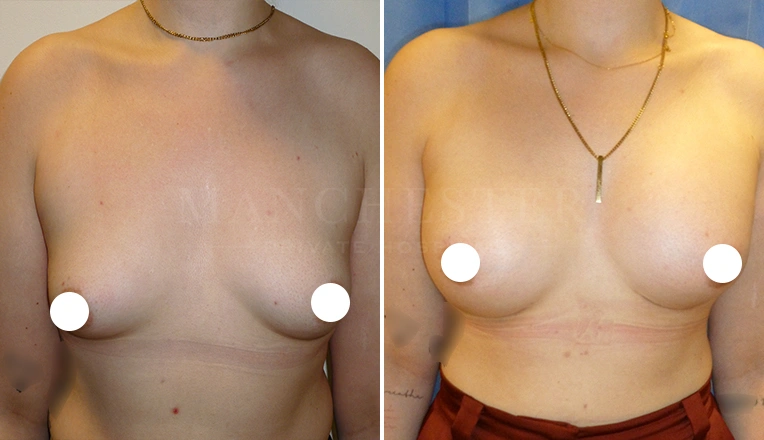 breast enlargement before and after result - patient 6