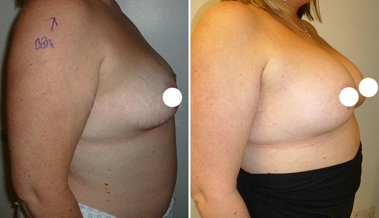 breast enlargement before and after result - patient 7