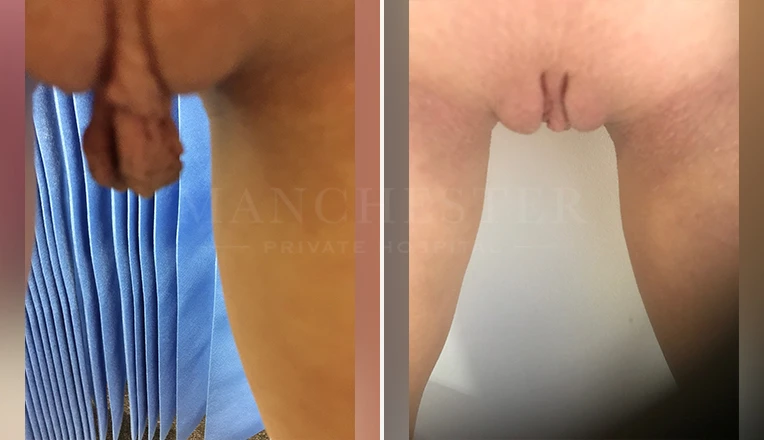 labia minora clitoral hood before and after patient-1