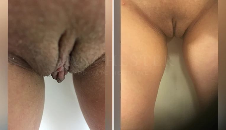 labia minora clitoral hood before and after patient-10