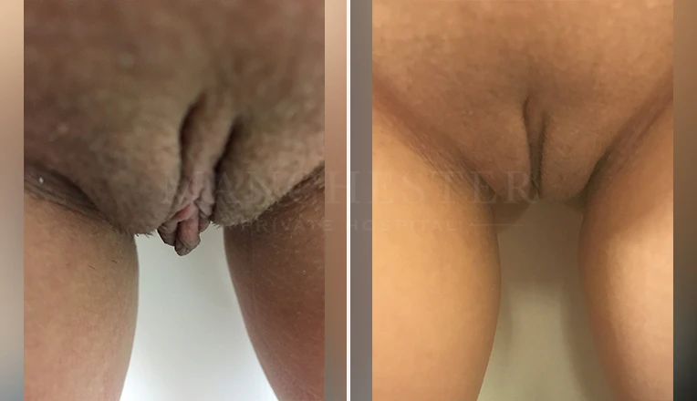labia minora clitoral hood before and after patient-6-v2
