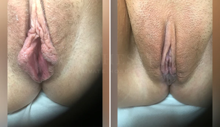 labia minora clitoral hood before and after patient-8