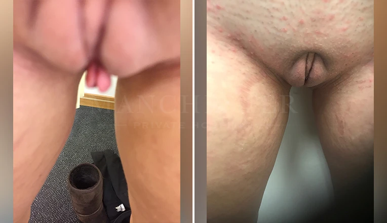 labia minora clitoral hood before and after patient-9-v1