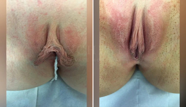 labiaplasty before and after patient-3