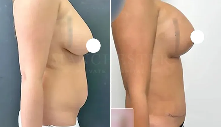 mummy makeover with tummy tuck and breast augmentation-v1