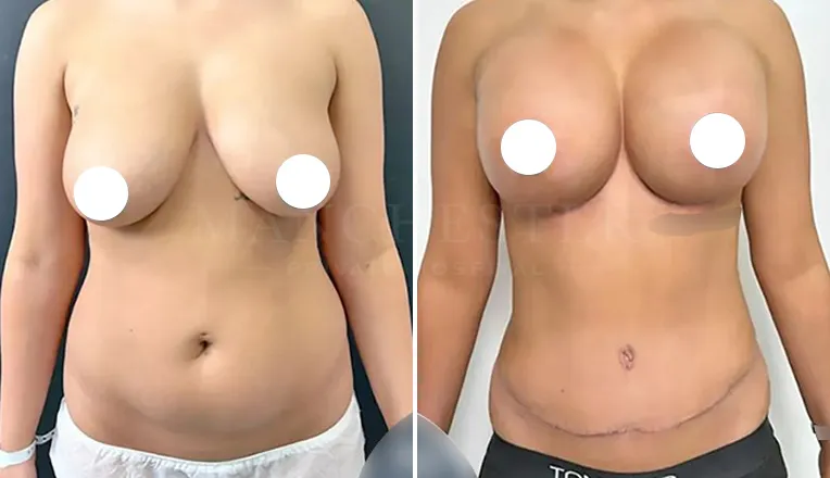 mummy makeover with tummy tuck and breast augmentation