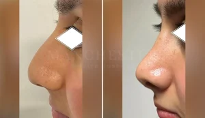 rhinoplasty before and after patient-11