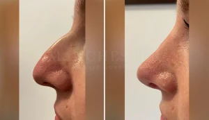 rhinoplasty before and after patient-12