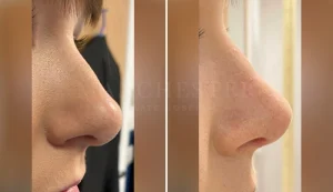 rhinoplasty before and after patient-13