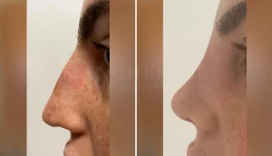 rhinoplasty before and after patient-14