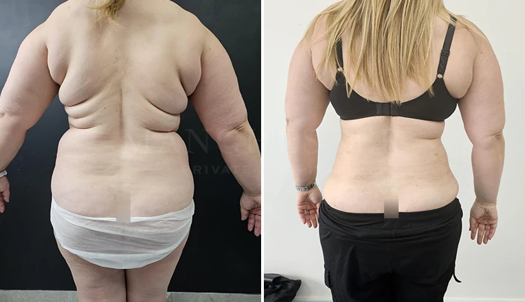 back vaser liposuction before and after-9