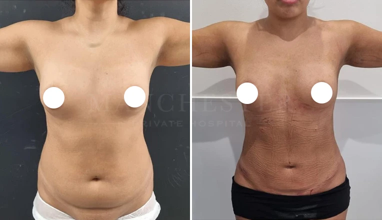 vaser lipo female abs before and after-10-v2