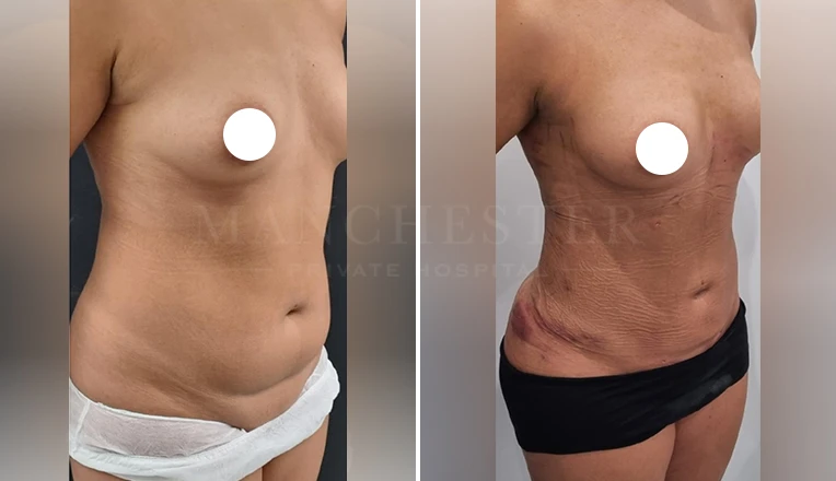 vaser lipo female abs before and after-10