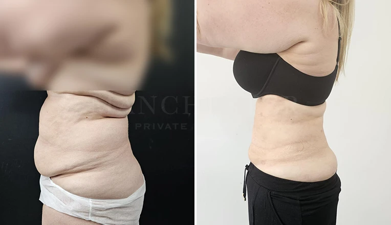 vaser lipo female abs before and after-9-v1