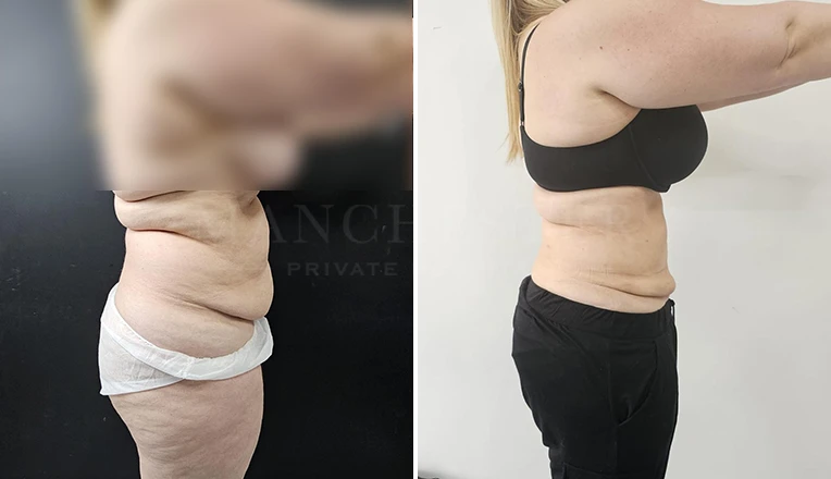vaser lipo female abs before and after-9-v2