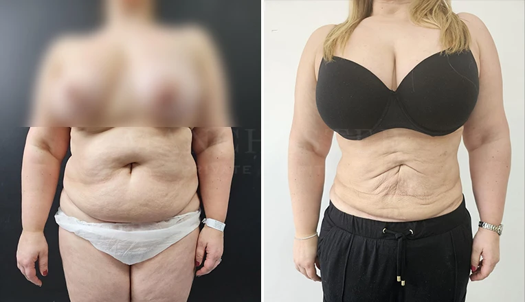 vaser lipo female abs before and after-9