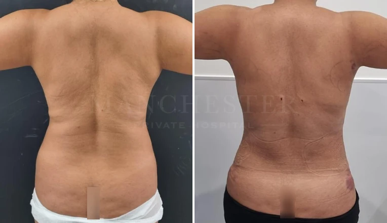 vaser lipo female back before and after-10-v1