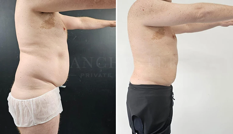 vaser lipo male abs before and after-11-v1