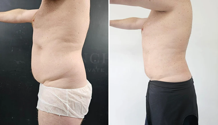 vaser lipo male abs before and after-11-v2