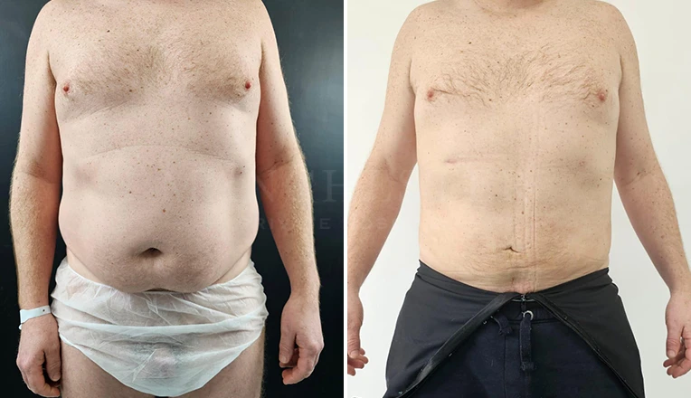 vaser lipo male abs before and after-11-v3