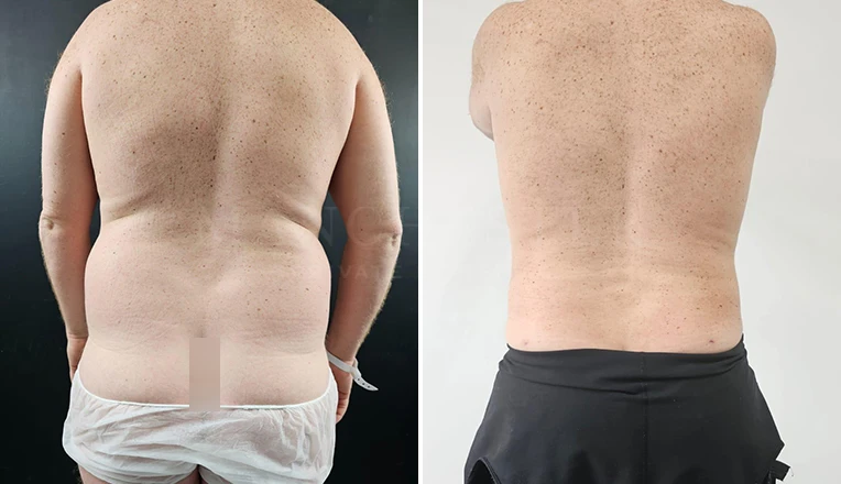 vaser lipo male back before and after-11